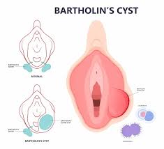 Image result for Bartholin's gland abscess