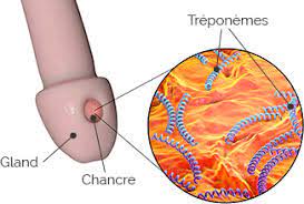 Maybe you would like to learn more about one of these? Chancre Mou Ce Qu Il Faut Savoir Sur Cette Ist