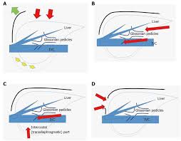 Valleylab, boulder, colorado), thunderbeat (olympus medical systems, corporation, tokyo, japan) and bipolar forceps. First Quarter Century Of Laparoscopic Liver Resection