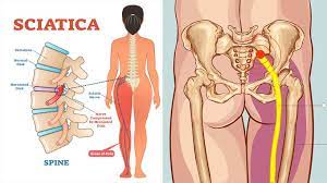 In tetrapod anatomy, lumbar is an adjective that means of or pertaining to the abdominal segment of the torso, between the diaphragm and the sacrum. Sciatica A Pain In The Bum Literally Equilibrium Sports And Spinal Clinic