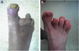 Image result for diabetic toes