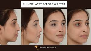 Rhinoplasty Before And After Rhinoplasty Nose Job Celebrity Plastic Surgery