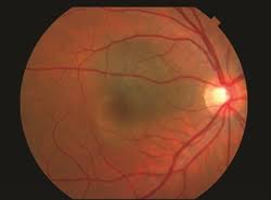Image result for nevus sclerae