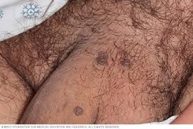 Image result for genital warts