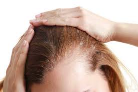 Hair loss info foot fungus may cause hair loss but since you have been experiencing hair loss and thinning for 10 years, it is most likely not the cause. Female Hair Loss How To Deal With Hair Loss When You Are A Woman