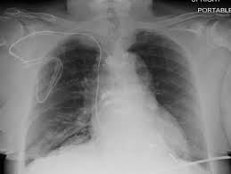 More advanced devices (icd, implantable cardioverter defibrillator; Mri Safely Performed In Patients With Pacemakers And Icds Eurekalert Science News