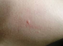 It's easy to confuse chigger and flea bites, but these two insects are very different. Insect Bites Reactions Types And Images