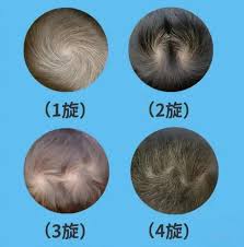 为什么每个人的头发都有“旋”? 两个旋更聪明?