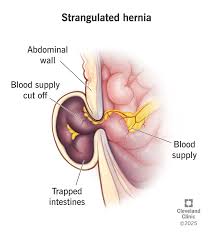 Image result for stomach hernia symptoms