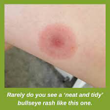 Lyme disease is caused by being bit by a tick that is carrying the disease. Lyme Disease Uk Lyme Disease And The Em Rash