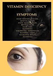 Alopecia, also known as losing hair or going bald, and is marked by a slowly receding hairline and balding. Vitamin Deficiency Symptoms Poor Wound Healing Mouth Ulcers Poor Night Vision Brittle Hair Hair Loss Dandruff Seborrheic Dermatitis Bleeding Gums Weakened Bones Diarrhea Luyase Dr Nicolace 9798746063984 Amazon Com Books