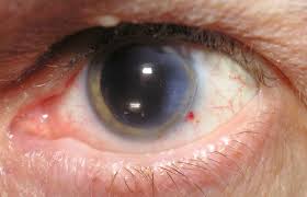 Cei mai mulți oameni vor trebui să poarte ochelari pentru viziunea de aproape sau la. Tot Ce Trebuie SÄ Ètii Despre ObÈinerea GratuitÄ A Cristalinului Pentru CataractÄ Click Mobile