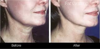 Fat transfer from $500 fat transfer for lip augmentation. Facial Fat Grafting In Toronto Facial Fat Transfer