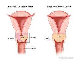 Cancer recurrence means the cancer you originally had has come back. Cervical Cancer Pictures Of Cervical Cancer Stages Symptoms Diagnosis Cleveland H University Hospitals