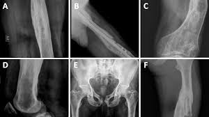 Image result for Osteomyelitis XRay