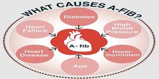 Atrial Fibrillation (Causes, Risk factors, and Complications) - Msrblog