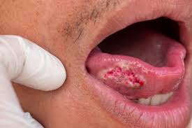 Image result for Oral herpes roof of mouth