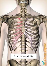 A sudden and sharp pain around your rib cage indicates that an i my names hannah i am 19 years old i am having pain under my rib on the right side of my body front and back i have heath issues but this is new do. Costochondritis Physio Check