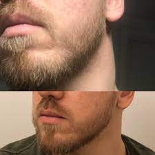 The reason it's more difficult to remove blonde hair through laser hair removal, and so, which laser systems will effectively remove blonde facial hair and body hair? Question About Blonde Beard 7 8 Weeks In 31 Year Old I M Blonde So My Beard Is Quite Light In Color Some Hairs Are Darker And Thicker But Many Are Thinner Light Hairs