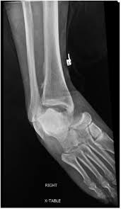 Image result for Ankle Dislocation