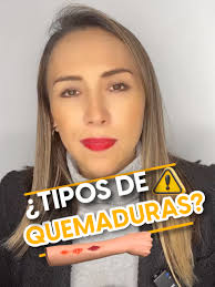 🔥 🌟 ¿Sabías que las quemaduras tienen diferentes etapas? En este video te  explico las características de cada tipo, desde las leves hasta las más  graves. Es importante entender cómo cuidar de nuestra ...