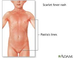Image result for Scarlet Fever