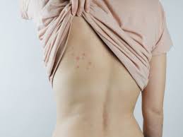 Tout savoir sur les punaises de lit. Piqure De Punaises De Lit Comment La Reconnaitre Et Comment Reagir Femme Actuelle Le Mag