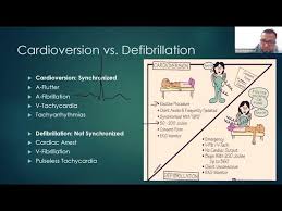 Image result for Synchronized Cardioversion