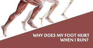 Discuss this with your doctor if you intend to use it for an extended period of time. Why Does My Foot Hurt When I Run
