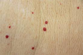 Bloedblaasjes Of Cherry Angioma S Huid Laser Utrecht Het zijn opeenhopingen van bloedvaten in de het is niet nodig om kersenwratjes te behandelen. huid laser utrecht