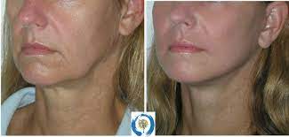 Thread lift procedures are considered safe when performed by an experienced doctor, using dissolvable threads, but it's still important to be aware of potential complications. Pdo Thread Lift For Sagging Skin I Restore Beauty I Loveland Fort Collins