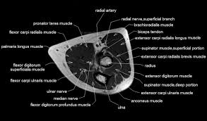 Mri of the knee may demonstrate bone marrow edema on one or both sides of the synchondrosis. E L B O W M U S C L E A N A T O M Y M R I Zonealarm Results