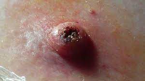 Itchy skin could be a sign of skin cancer if it is accompanied by: Keratoacanthoma Definition And Patient Education