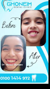 يتم علاج بروز الفك السفلي و العضة الامامية المعكوسة باستخدام اجهزة تقويم  الفكين قبل سن ١٠ سنوات وذلك لضمان افضل نتيجة, د. أحمد غنيم, أخصائي التقويم,  زمالة تقويم الأسنان البريطانيه ،ادنبره, للحجز و ...