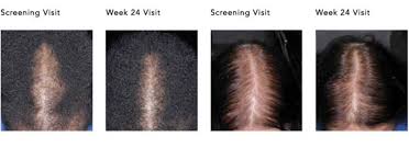 Minoxidil and finassteride.since women can't use finasteride, minoxidil is the only efffective means to treat female hair loss. Everything You Need To Know About Rogaine For Women The Skincare Edit