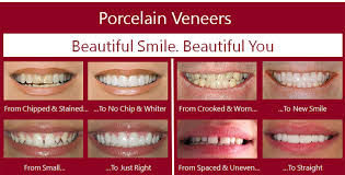 Veneers are a type of cosmetic dentistry for crooked teeth which. Porcelain Veneers Aria Dental Mission Viejo Ca