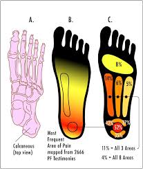 Key facts about the medial plantar muscles. Plantar Fasciitis Wikipedia