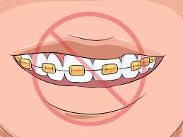 كيفية اختيار لون تقويم الأسنان: 14 خطوة (صور توضيحية) - wikiHow