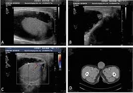 Maybe you would like to learn more about one of these? Radiologic Findings Of Mesothelioma At The Tunica Vaginalis Urology