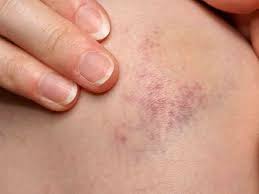 Many of the red, pink, or brown spots you find on your skin are harmless, but some can signal serious skin issues or diseases. Petechiae Causes Treatments Pictures And More