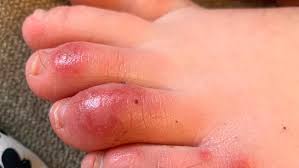 Many others are experiencing horrific co. Covid Toes Other Rashes Latest Possible Rare Virus Signs Wham