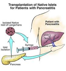 The warning signs that are generally observed in pancreatic cancer patients are: Pancreatitis Physiopedia