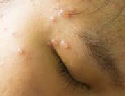Kesan chicken pox di belakang badan. Pengobatan Cacar Air Pada Anak Yang Perlu Bunda Ketahui Alodokter