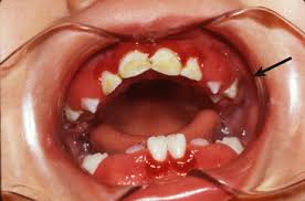 20 Gingivitis And Periodontal Disease Pocket Dentistry