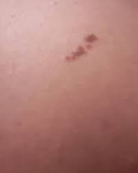 Heureuses les amours qui se dénouent sans détours. Grains De Beaute Dans Le Dos Risque Forum Dermatologie Journal Des Femmes