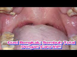 Radang gusi atau gingivitis adalah peradangan pada gusi yang ditandai oleh memerahnya gusi di sekitar akar gigi.gingivitis terjadi ketika sisa makanan di gigi dan gusi mengeras menjadi plak. Cara Mengatasi Gusi Bengkak Dengan Mudah Bisabo Channel