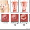 This result means the cells collected for the pap smear appear so abnormal that the pathologist is almost certain a cancer is present. 1