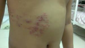 Image result for shingles in children
