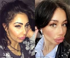 Bà mẹ đơn thân gây sốc với đôi môi “tràn trề bờ đê”