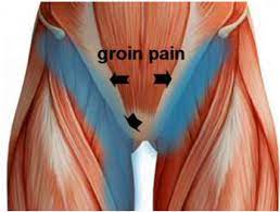 There are many potential causes of a lump in this area. What Is Your Groin Pain Rhp Physiotherapy